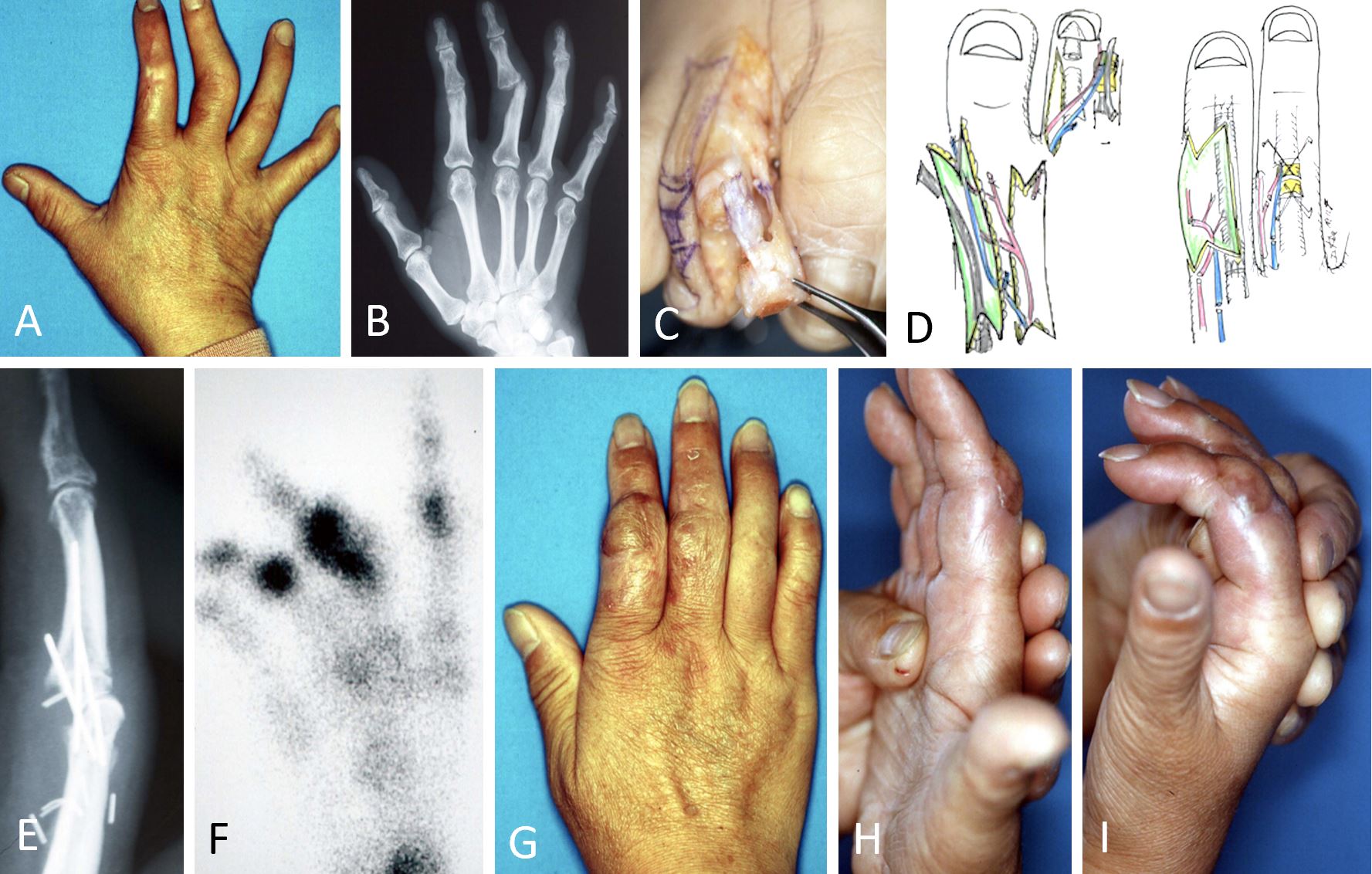 Free Vascularized SecondToe Distal Interphalangeal Joint Transfer for